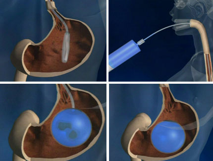 balon-intragastrico.jpg
